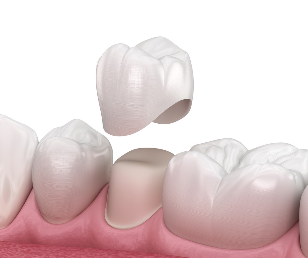 Dental Crowns in Adelaide