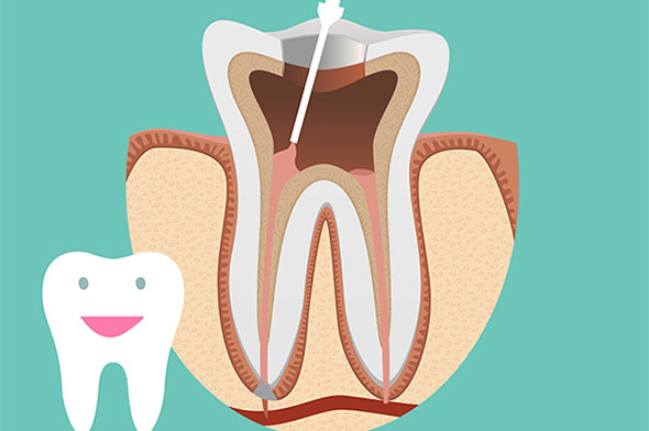 Root Canal Treatment in Adelaide