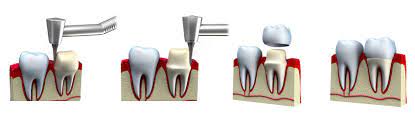 Dental Crown treatments in Adelaide