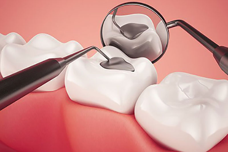 Dental Fillings Adelaide