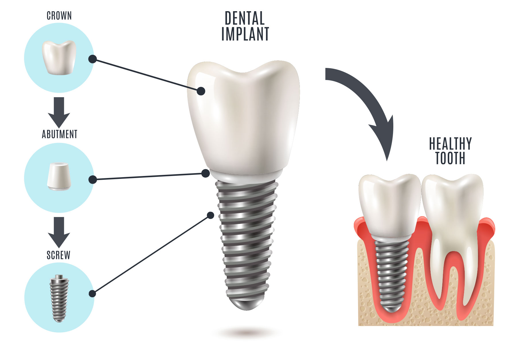 dental implant