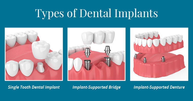 Dental Implants Adelaide