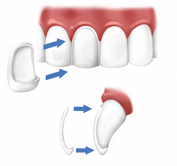 Dental Veneers